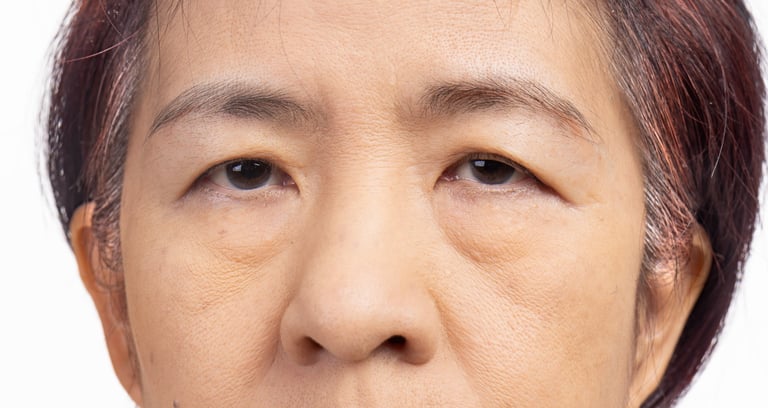 Droopy eyelids before upper eyelid treatment
