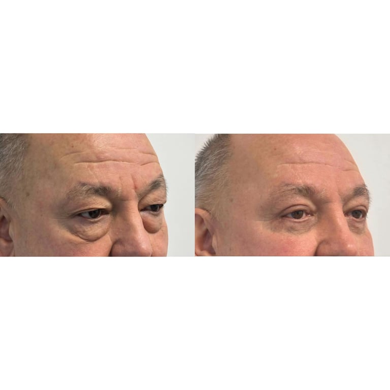 Before and after comparison of upper eyelid area showing cosmetic treatment results, with reduced drooping and puffiness on the right